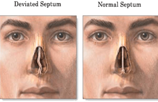 rhinoplasty-for-a-deviated-septum-westside-head-neck