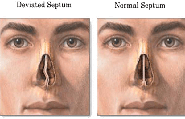 Rhinoplasty For a Deviated Septum | Westside Head & Neck