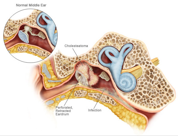 Causes Symptoms And Diagnosis For Cholesteatoma Westside Head And Neck